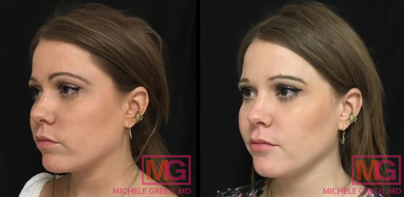 Woman treated with Botox and Juvederm Ultra Plus