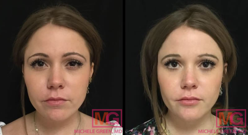 Botox eyes lines glabella and chin ultra plus FRONT