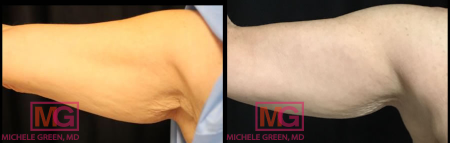 Thermage and Coolsculpting arms - 6 months before and after