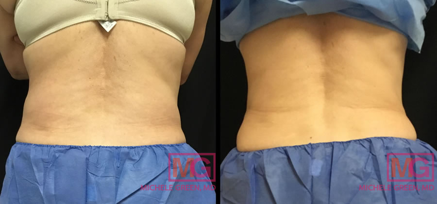 LG 59 coolsculpting flanks 4 5 months MGwatermark