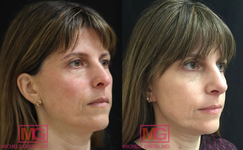 LL 35 44 before after thermage and injectables jan 2018 ANGLER 1 MGwatermark