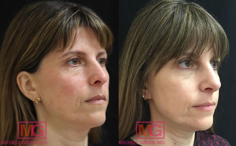 LL 35 44 before after thermage and injectables jan 2018 ANGLER 1 MGwatermark