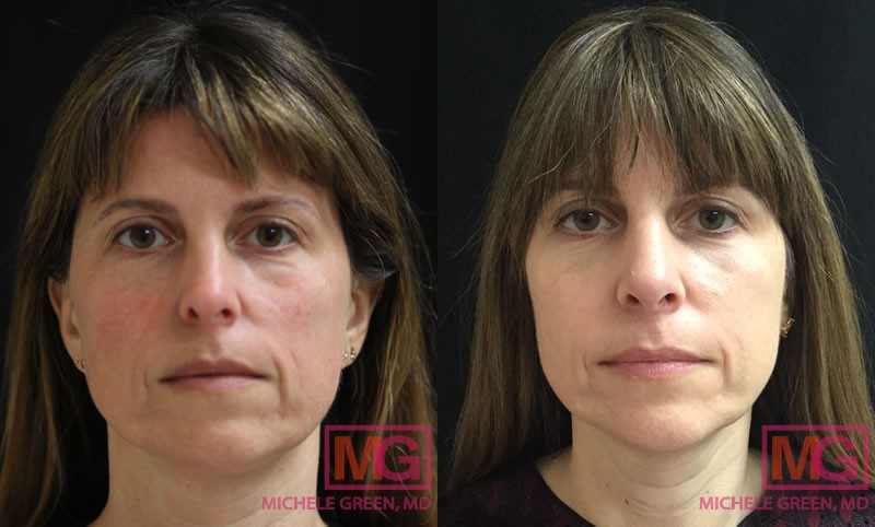 LL 35 44 before after thermage and injectables jan 2018 FRONT 2 MGwatermark