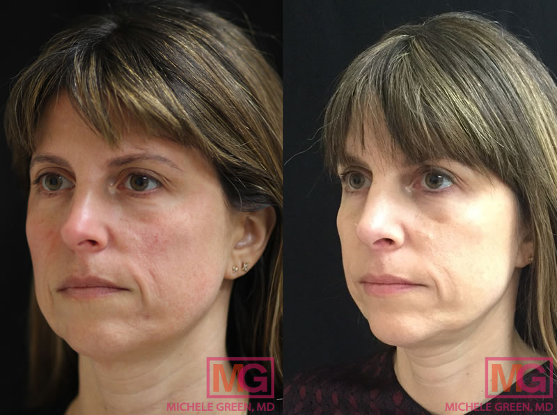 35-44 year old female after chemical peels and vbeam