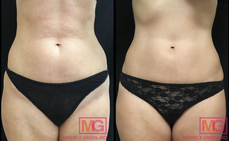 How CoolSculpting Significantly Reduced One Woman's Midsection