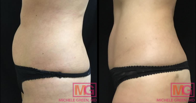 LL coolsculpting 10m LSIDE 1 MGwatermark 1