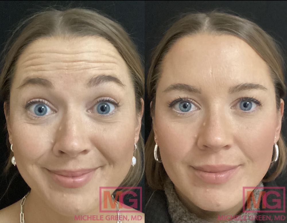 34 year old Female, botox before and after - 3 weeks
