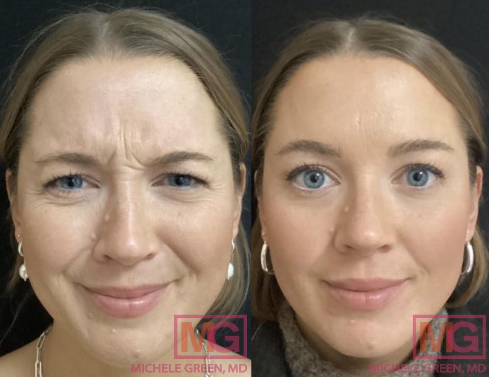 34 year old Female, botox before and after - 3 weeks