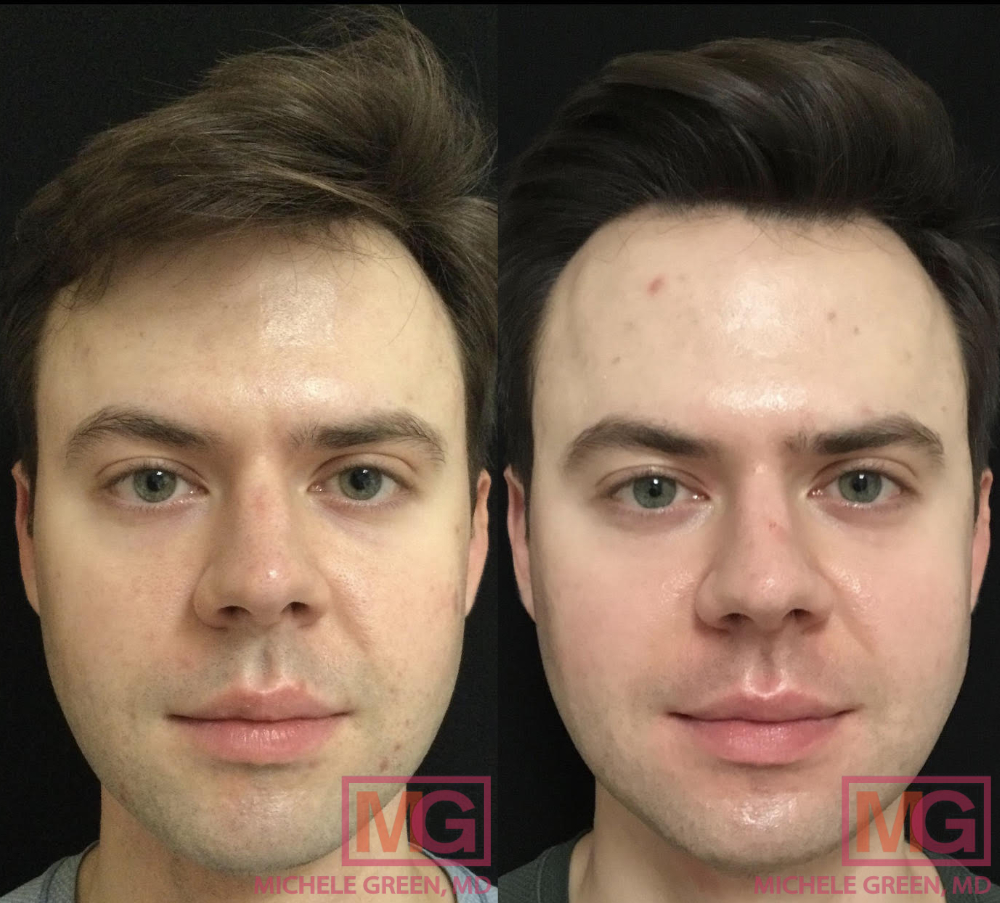 27 yo male 4 sessions Ematrix 3 VBEAM 1 syringe Restylane acne scars 4 month