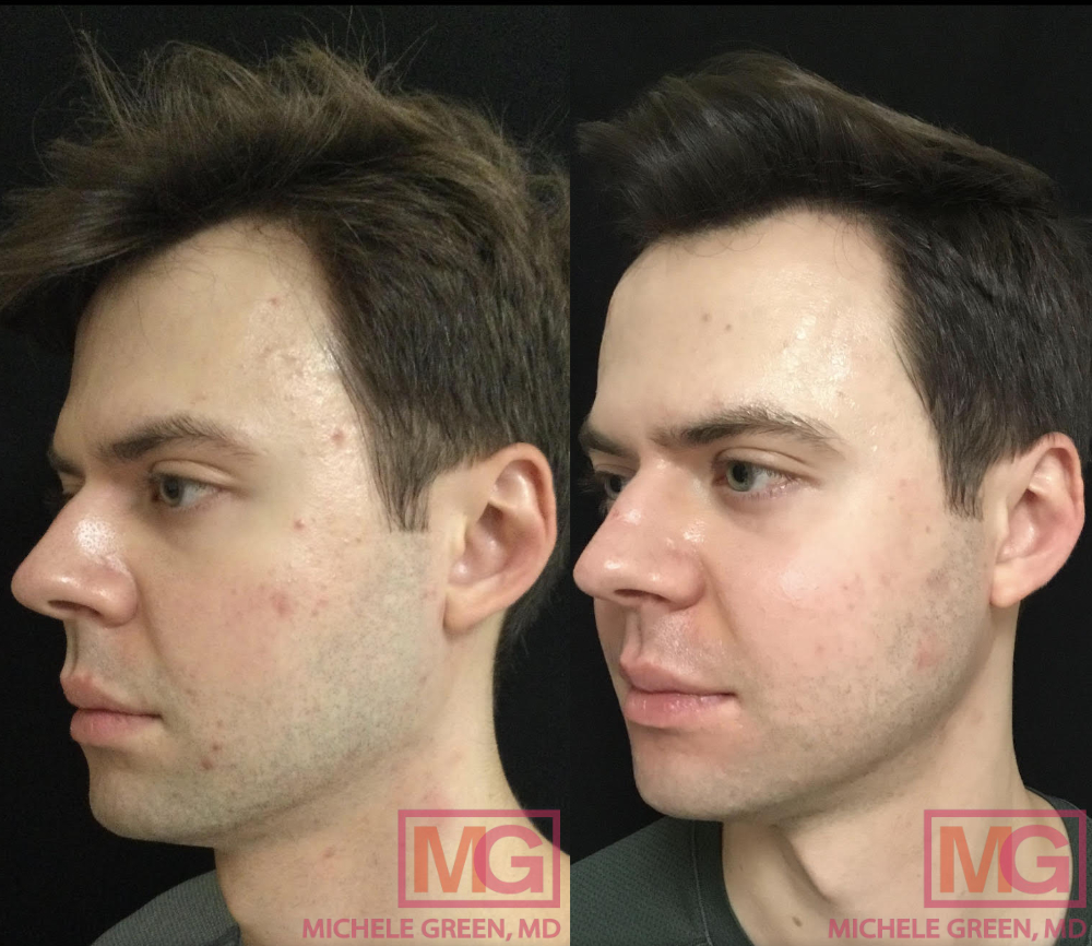 27 yo male 4 sessions Ematrix 3 VBEAM 1 syringe Restylane acne scars 4 month