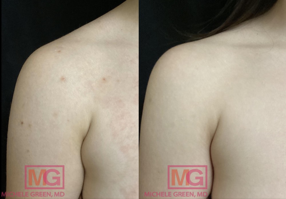 LT 25 yo female before and after Kybella x3 in bra fat 4 months apart MGWatermark
