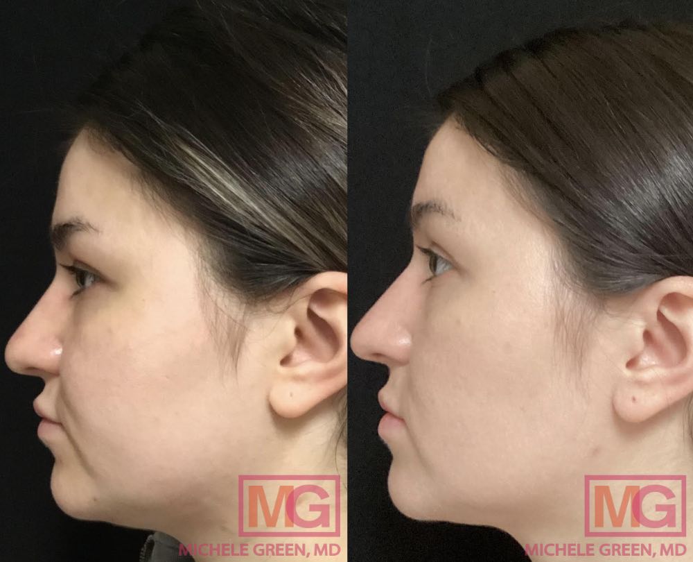 LT 25yo female before and after Kybella submental x4 1 and a half years apart MGWatermark