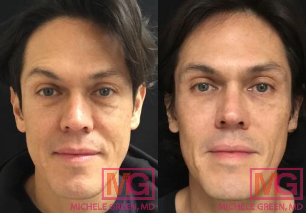 50 year old male - Restylane treatment under eyes