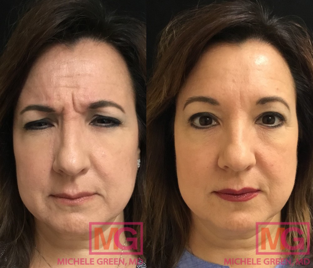 55 year old, Botox for Glabella area, 2 weeks