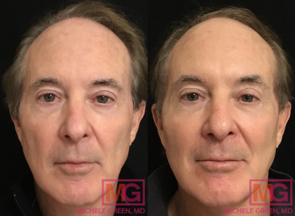 50-59 year old, 2 vials of Sculptra - 1 month