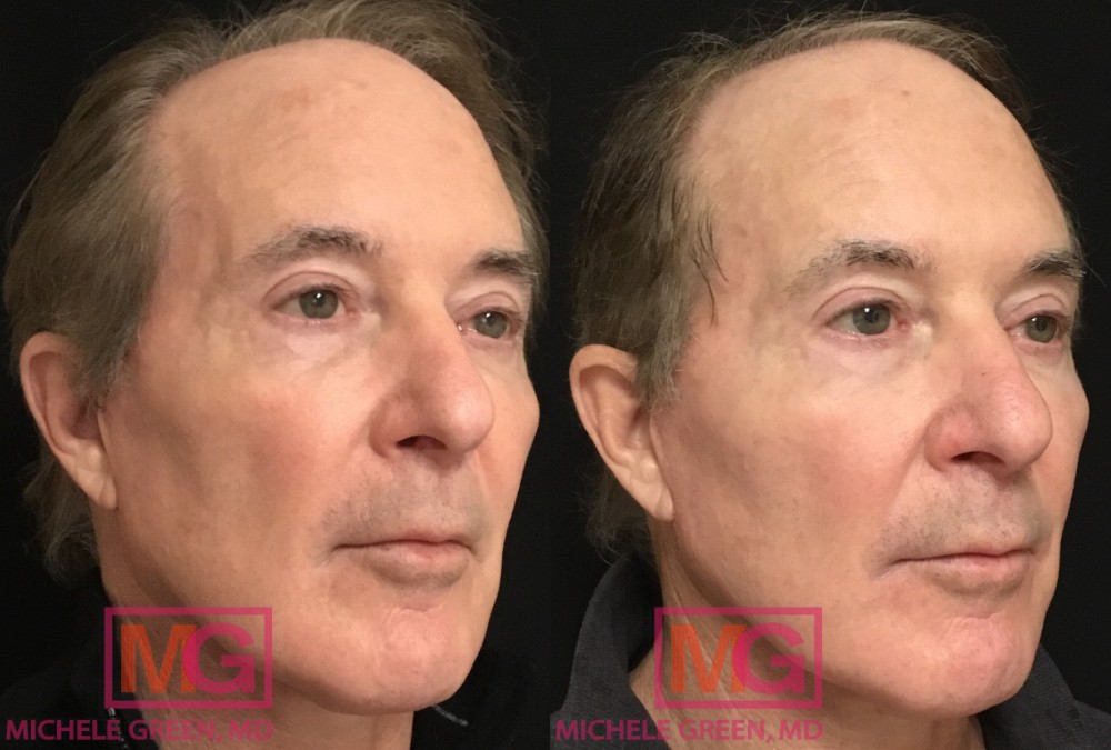 M.C 1 month Before and After Sculptra 2 vials2 MGWatermark 1