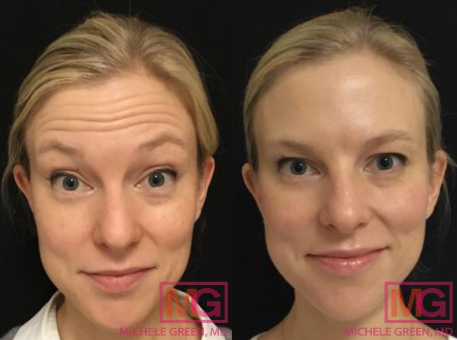 M.J 38 yr old Before After Botox Forehead MGWatermark