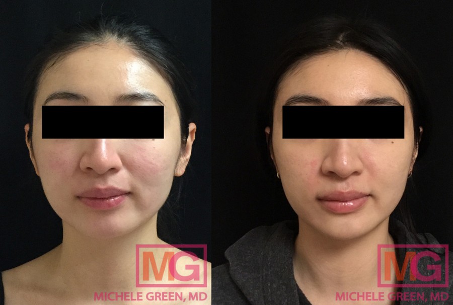 26 year old, Acne treatment with eMatrix, 5 months
