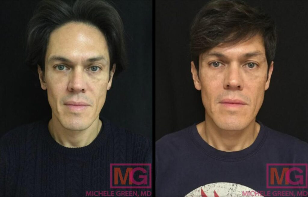 MA botos juvederm 3m FRONT