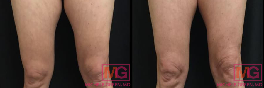 CoolSculpting thighs, female, 5 months