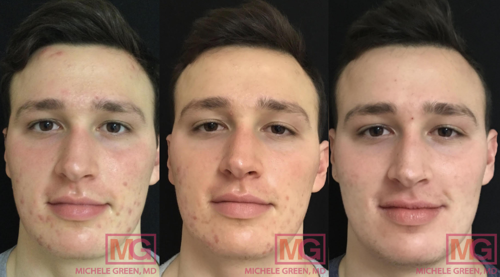 MG 19 before after accutane acne 1 to 5months MGWatermark