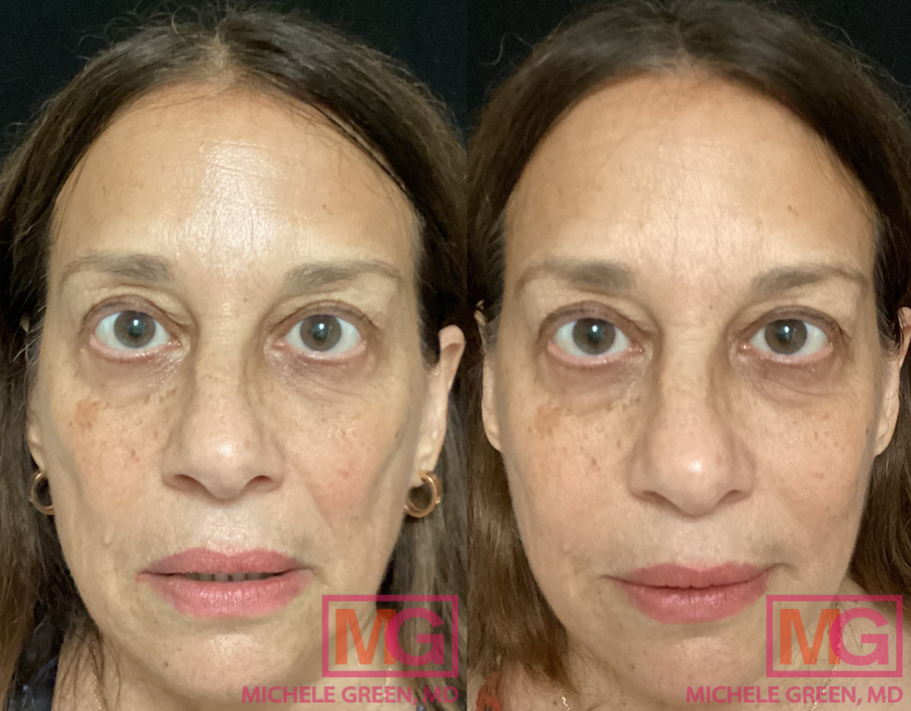 66 year old before & after Juvederm & Restylane