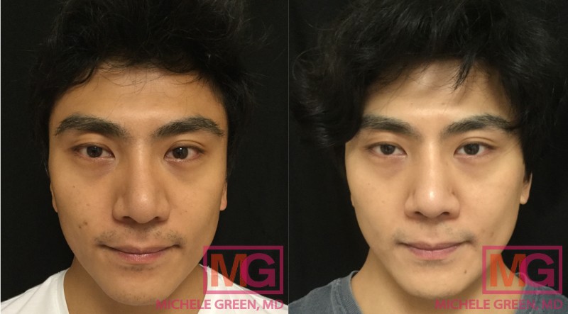 MH 34 Before and After Chemical Peel 4 sessions 6 months MGWatermark 1