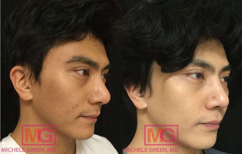 MH 34 Before and After Chemical Peel 4 sessions 6 months RIGHT MGWatermark
