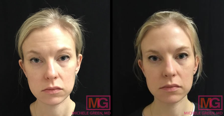 MJ botox 2 weeks FRONT 5 MGwatermark