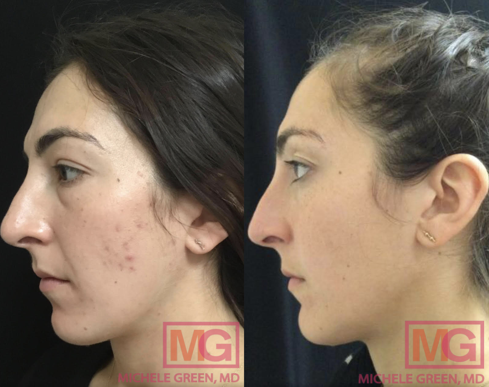 Female Age 30-40, Before and after 5 months of Accutane