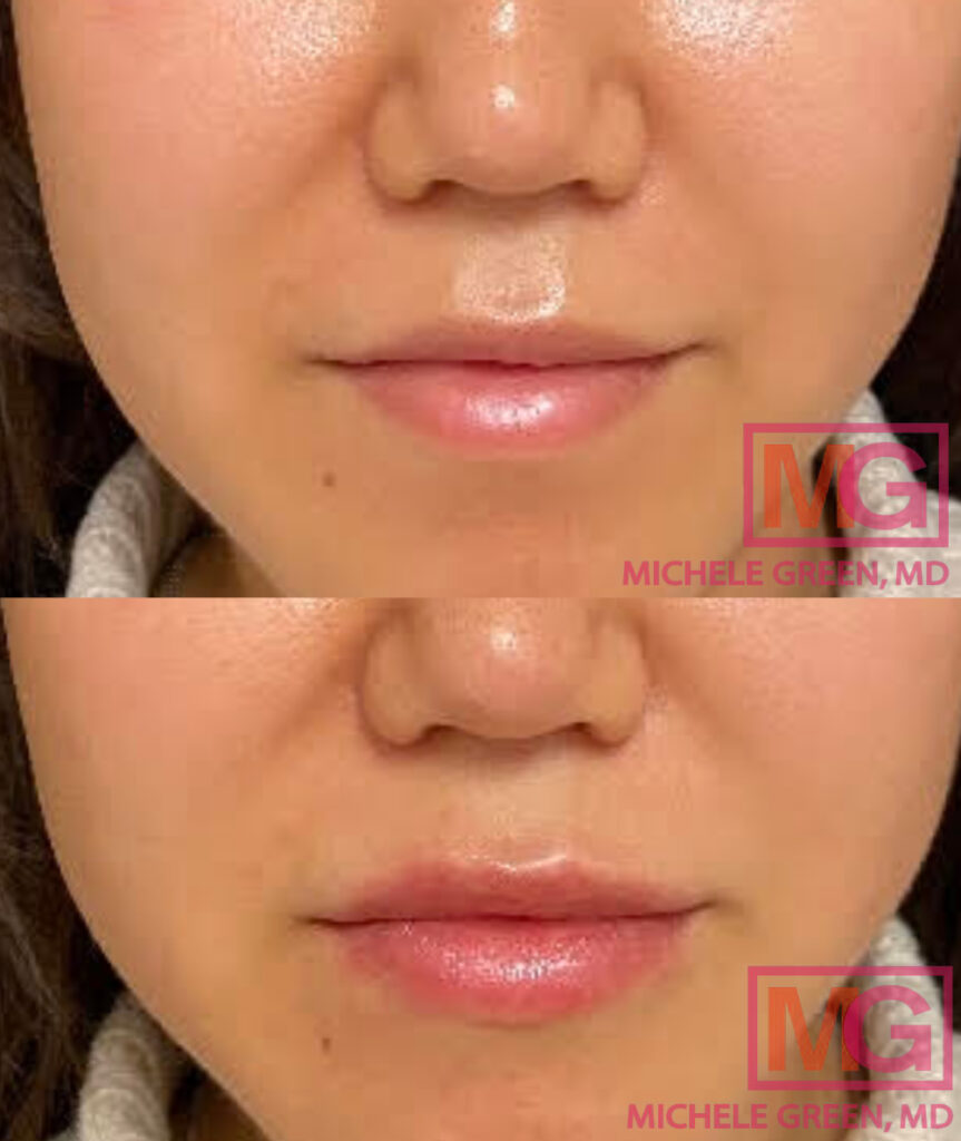 ML 28yo Before after restylane lip filler MGWatermark LIPS ONLY