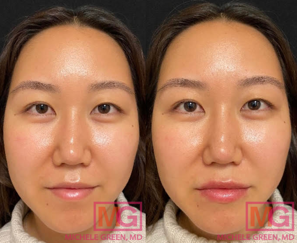 Restylane filler before and after