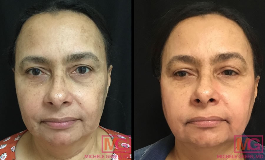 55-64 year old woman treated with chemical peels 