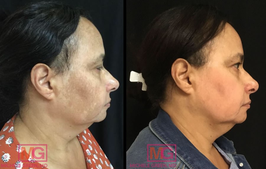55-64 year old woman treated with chemical peels