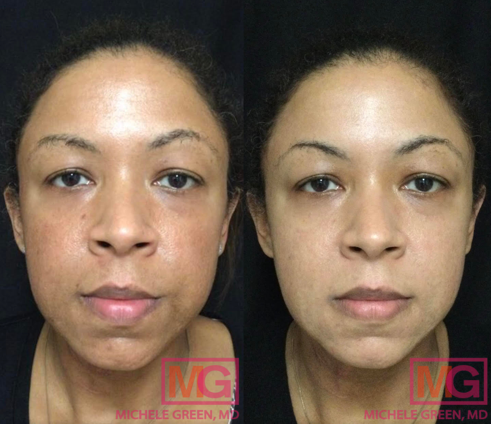 46 year old female before and after Cosmelan treatment - 4 months