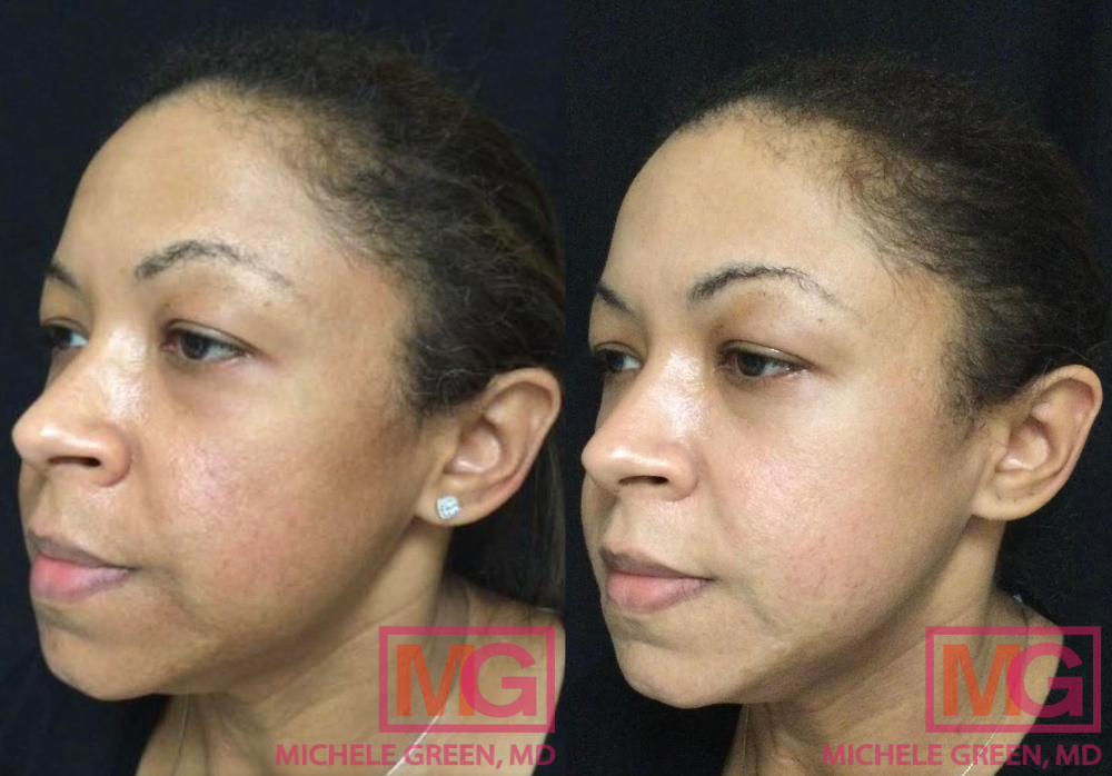 46 year old female before and after Cosmelan treatment - 4 months