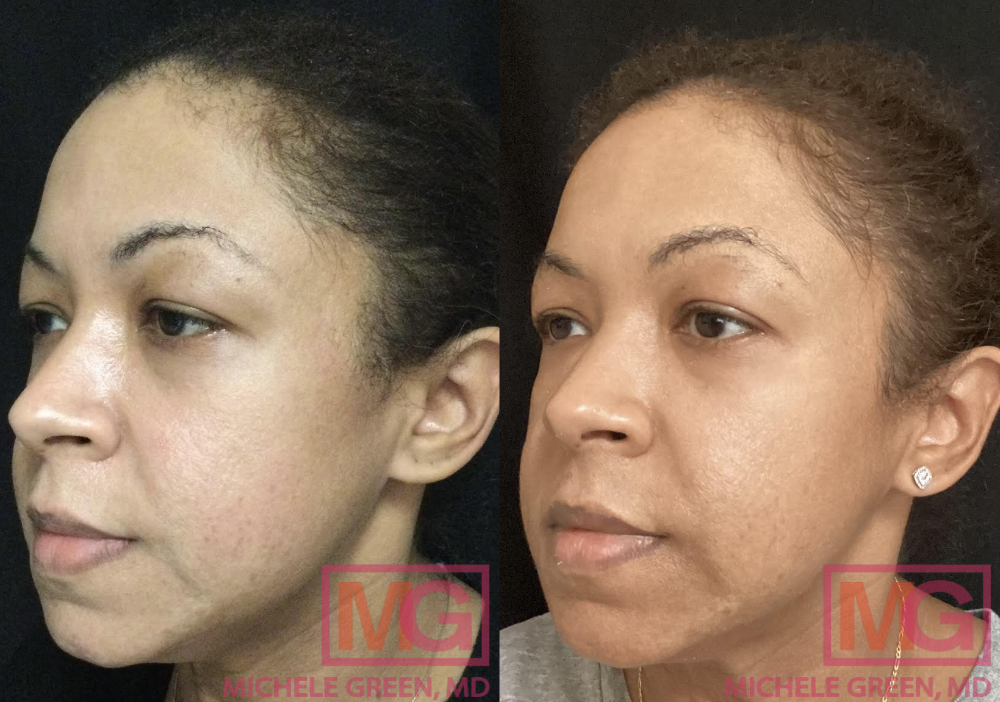 MR 6 months before after Cosmelan and 1 microneedling with depigmentation serum LEFT MGWatermark