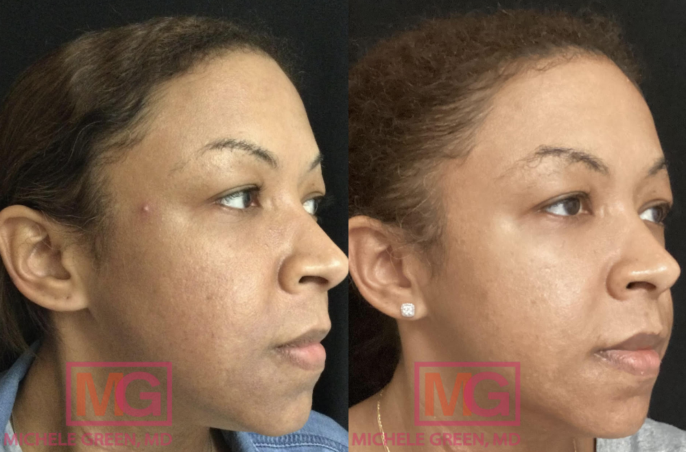 MR 6 months before after Cosmelan and 1 microneedling with depigmentation serum RIGHT MGWatermark