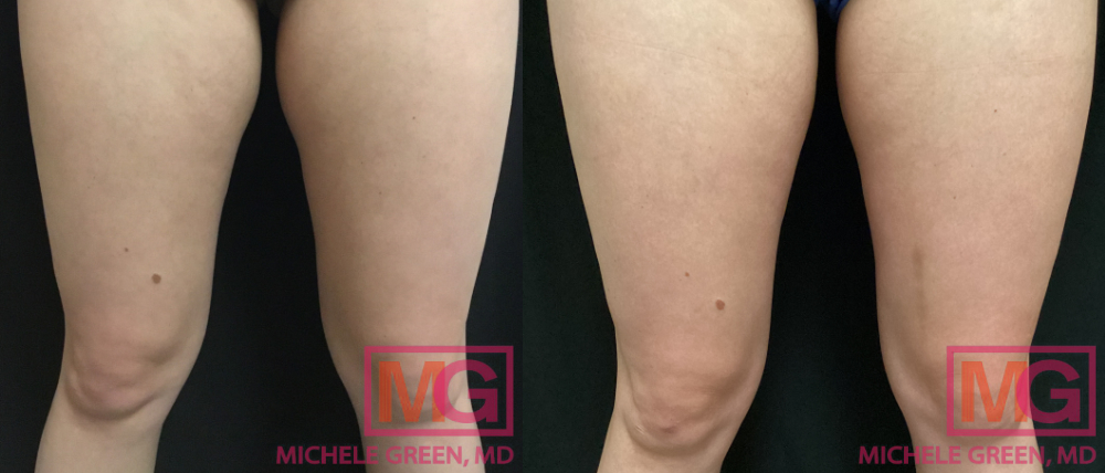 MR before after Coolsculpting MGWatermark