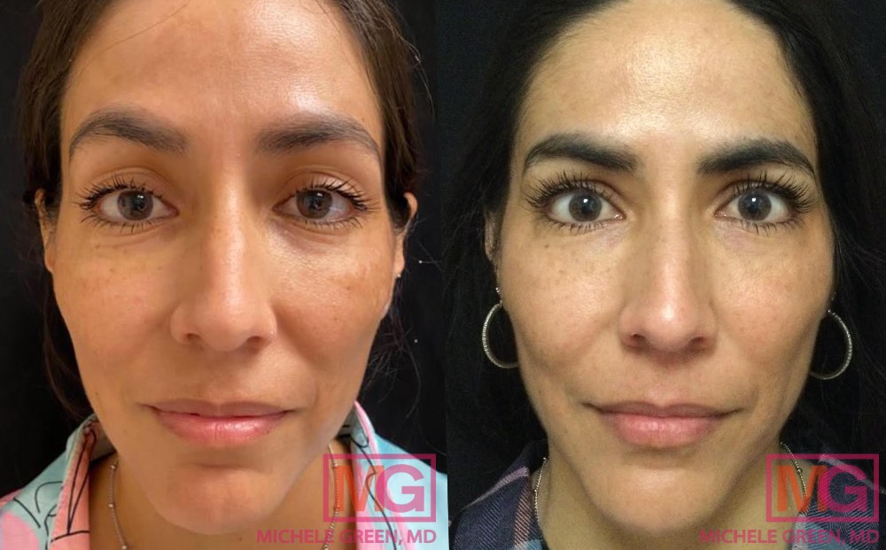 MS before and after restylane under eye and Voluma for cheeks 2 months MGWatermark 1