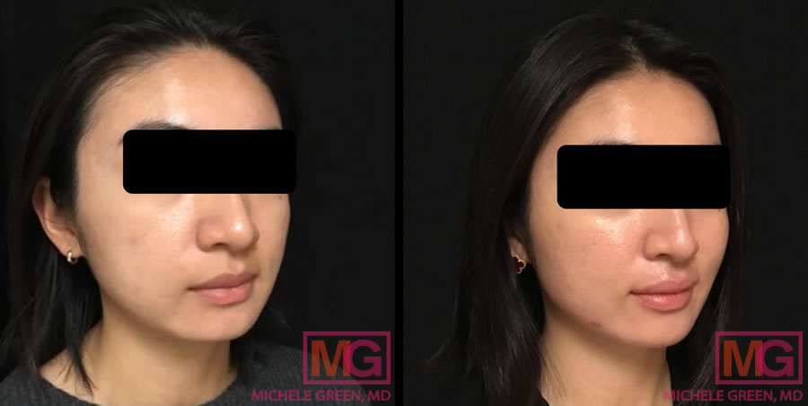 25-34 year old Female, acne treatment with Accutane, 3 months