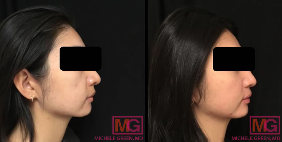 MX 26 acne accutane 4 months RIGHT