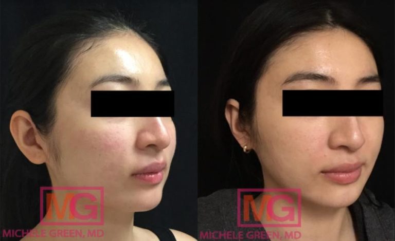 eMatrix™ NYC, eMatrix Sublative Rejuvenation Treatments