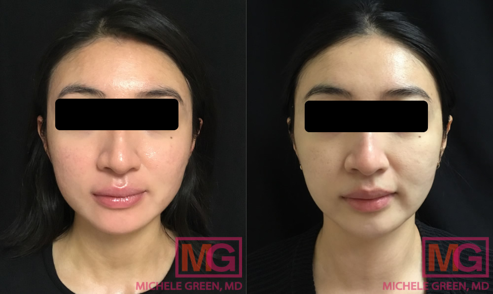 26 year old Female 8 months before and after VBeam