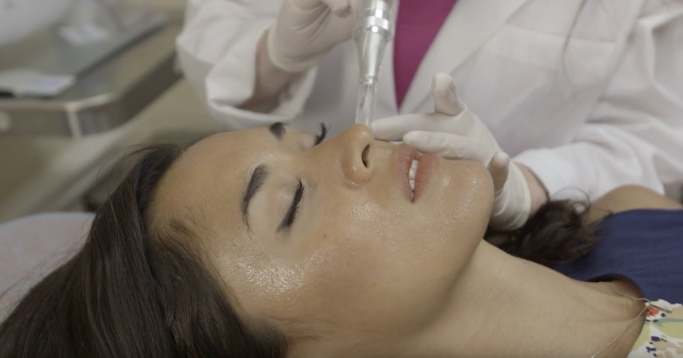 Microneedling still