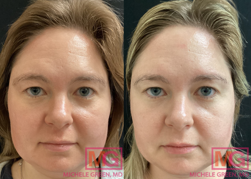 NB 36yo female Vbeam Clear and Brilliant MGWatermark