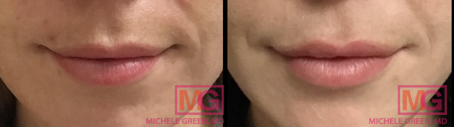 NS31 juvederm ultra plus lips 1 syringe before after 1 MGwatermark