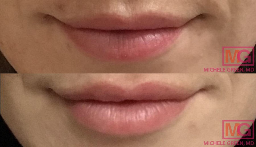 NS31 juvederm ultra plus lips 1 syringe before after 1 SQ