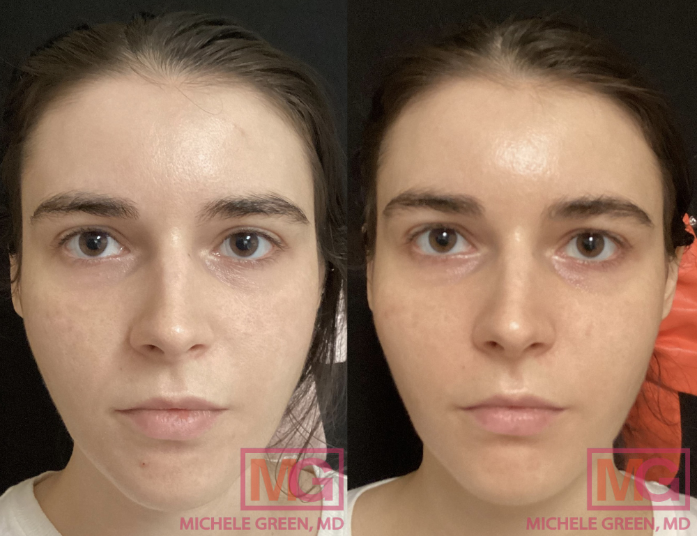 Restylane for Nasolabial folds - 1 month