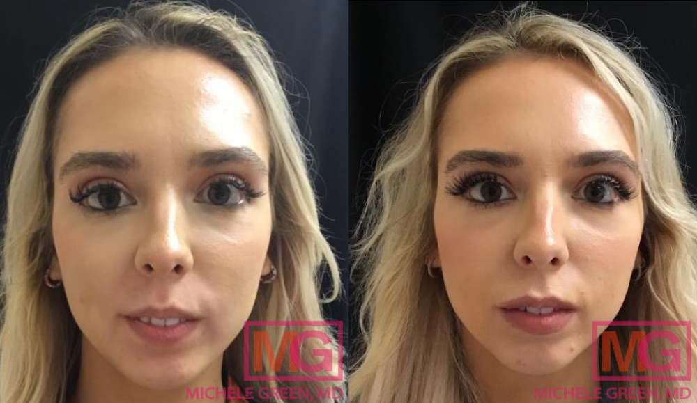 P.C 28yr old female Before After Juvederm Ultra Plus Lip Injections MGWatermark